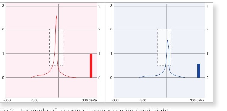 Example of a normal tympanogram — right ear in red, left ear in blue