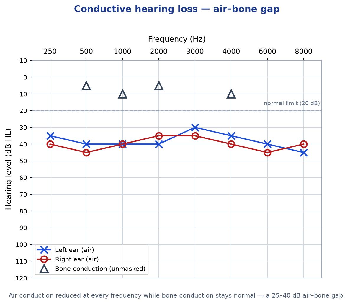 Audiogram showing a conductive hearing loss, with air conduction thresholds reduced while bone conduction thresholds remain normal