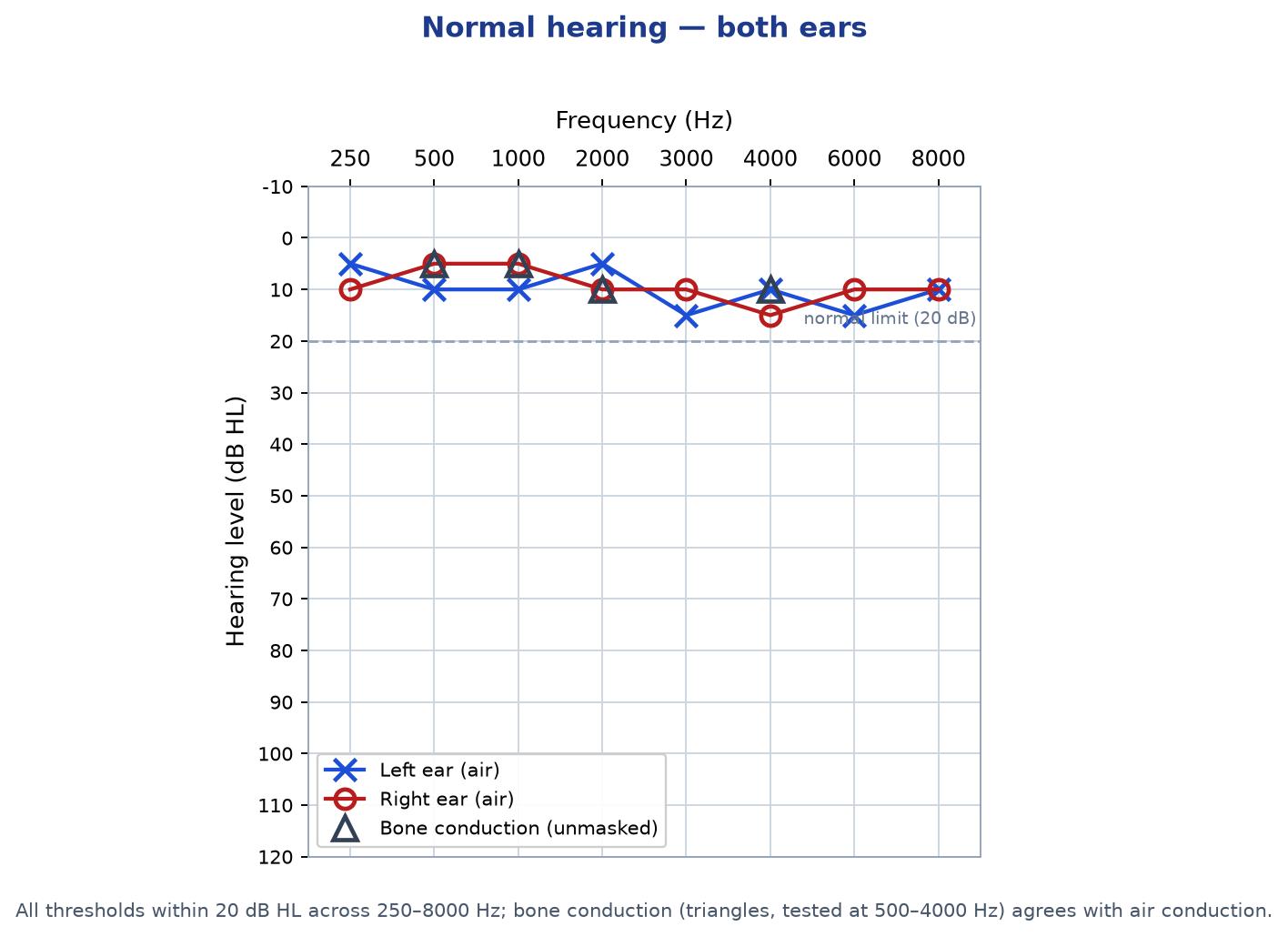 Audiogram showing normal hearing, with red circles for the right ear and blue crosses for the left ear all plotted near the top of the chart
