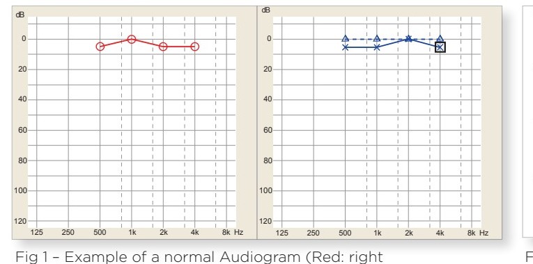 Example of a normal audiogram — right ear in red, left ear in blue