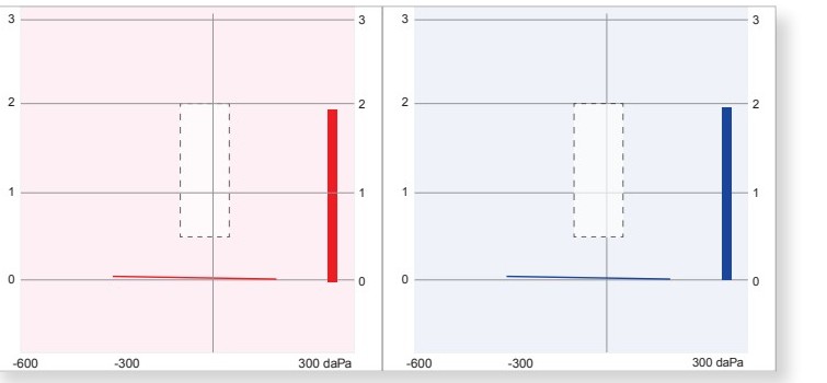 EE's tympanogram showing a flat type B trace