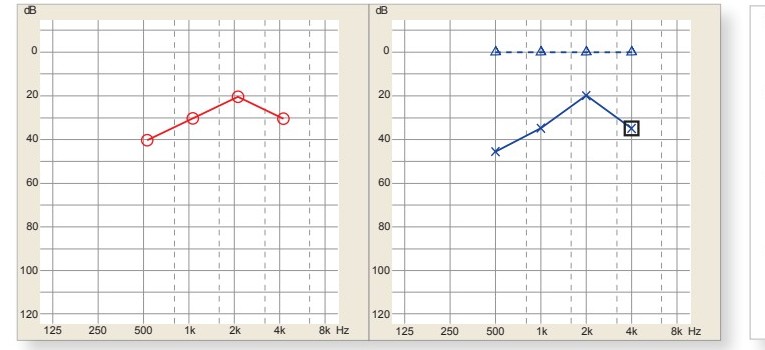 EE's audiogram showing bilateral mild conductive hearing loss